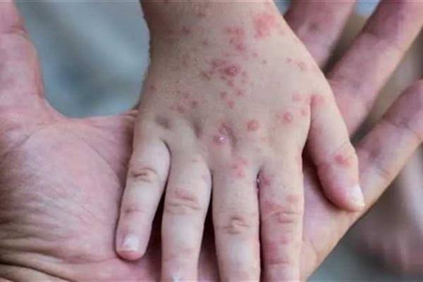 سيراليون: تسجيل أكثر من 3000 حالة إصابة بفيروس جدري القردة و14 حالة وفاة